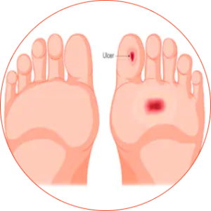 Screening piede diabetico